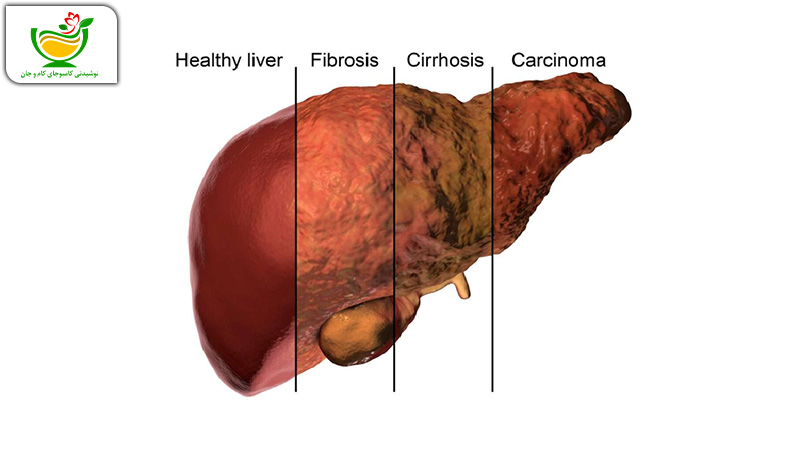 بیماری های فیبروز، سیروز و کارسینوم کبدی