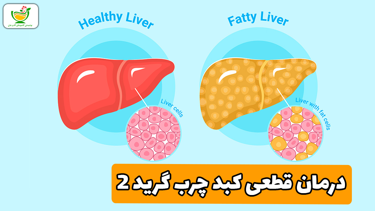 درمان قطعی کبد چرب گرید 2