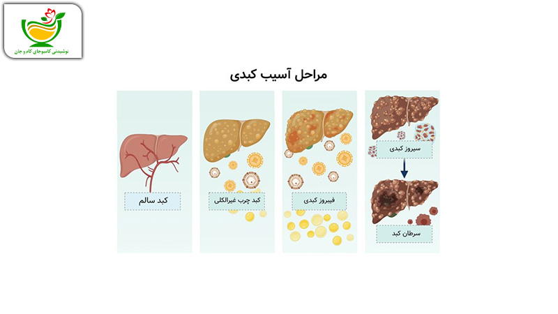 مراحل آسیب کبدی