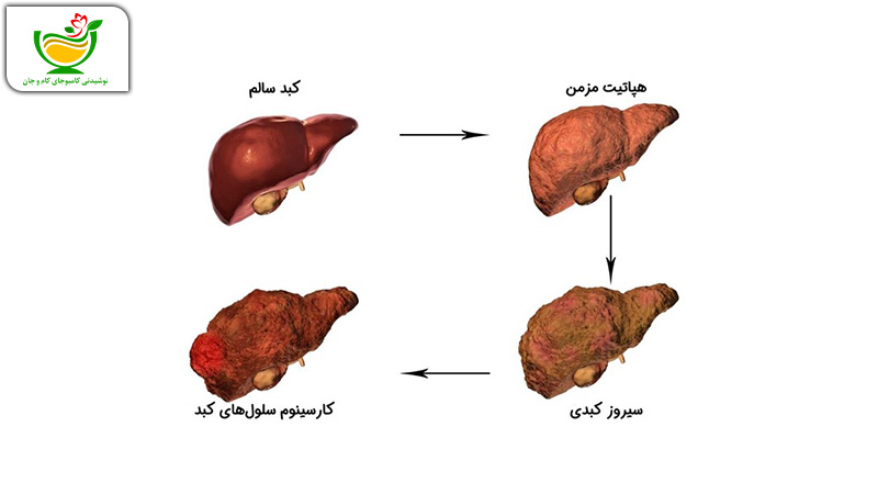 سیروز کبدی