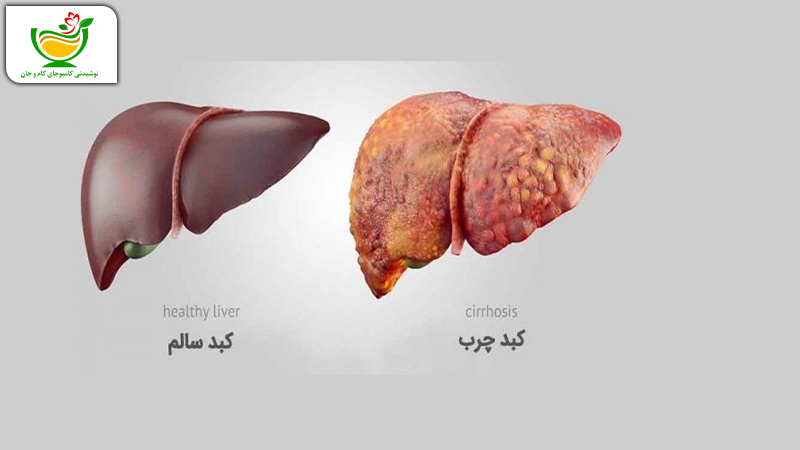 درجه بندی بیماری کبد چرب